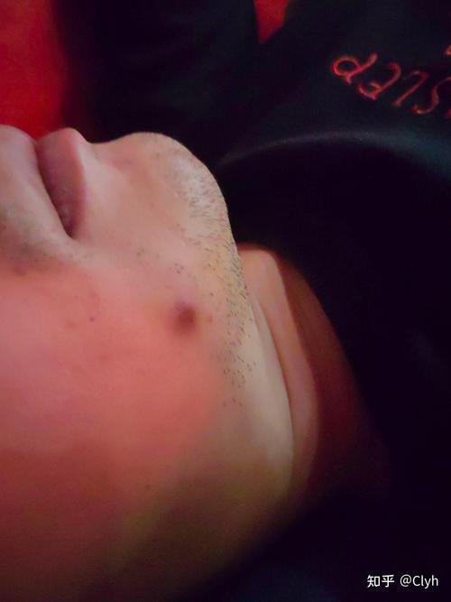 脸皮下硬疙瘩是何原因?需警惕哪些问题?