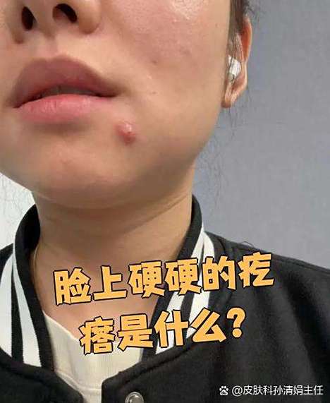 脸皮下硬疙瘩是何原因?需警惕哪些问题?