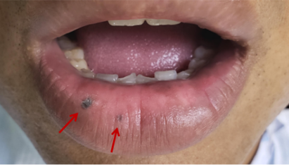 口腔内壁黑点是何原因?需警惕吗?