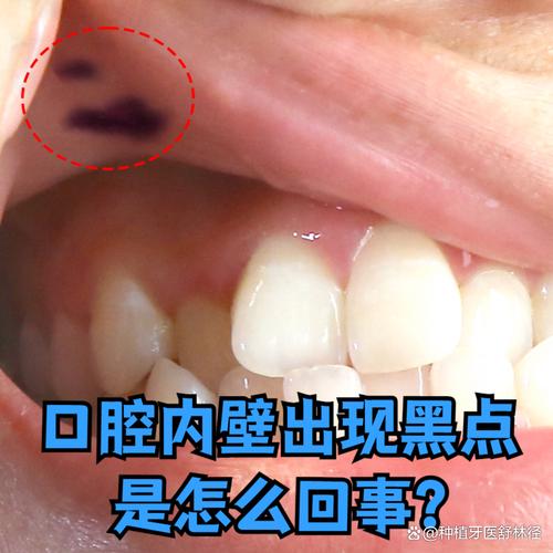 口腔内壁黑点是何原因?需警惕吗?