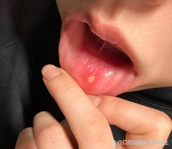 口腔溃疡快好了的图片
