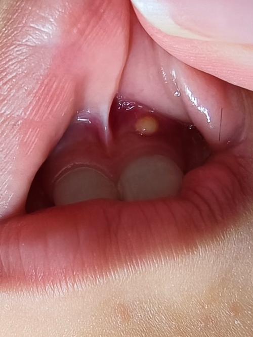 2岁宝宝口腔溃疡图片什么样?怎么护理?