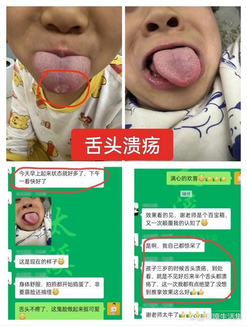 为何舌头总长口腔溃疡?