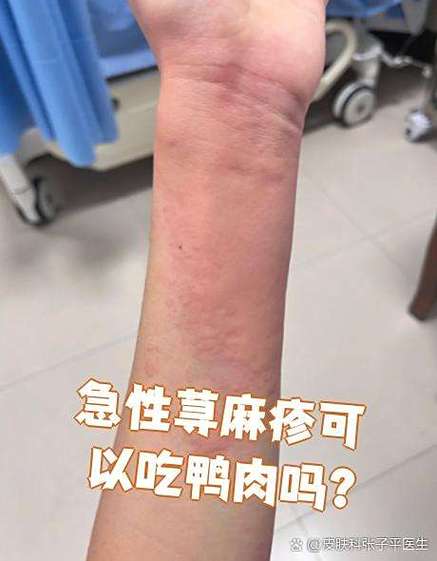 皮肤过敏能吃鸭肉吗?