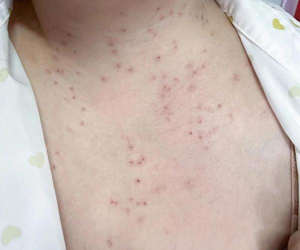 菌丝阳性是哪种皮肤病?