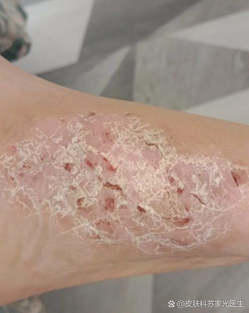 菌丝阳性是哪种皮肤病?