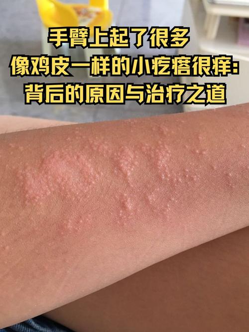 菌丝阳性是哪种皮肤病?