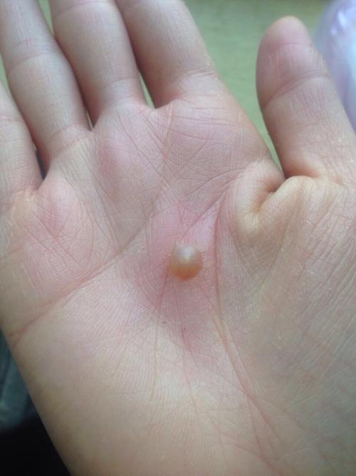 手掌皮肤内现硬疙瘩,是何原因?