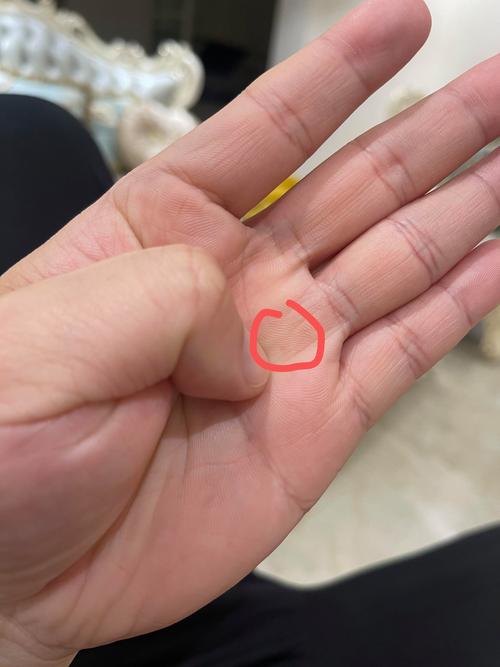 手掌皮肤内现硬疙瘩,是何原因?