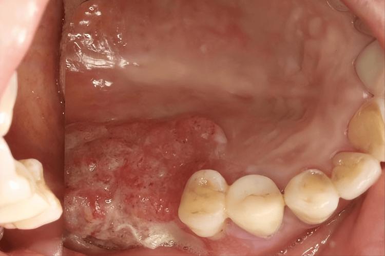 口腔里长了个红色的泡