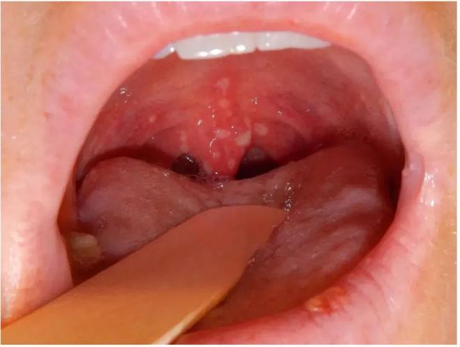 口腔里长了个红色的泡