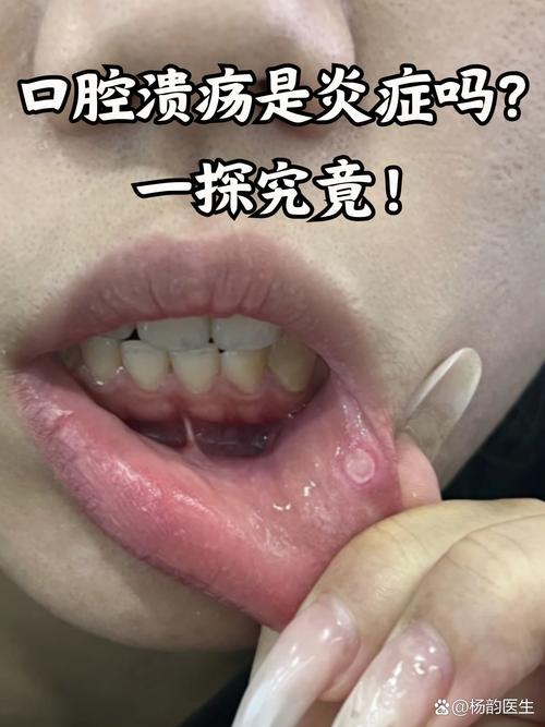 洗牙后为何总口腔溃疡?是正常反应吗?