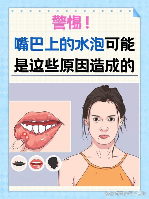 口腔粘膜水肿能自行消退吗?