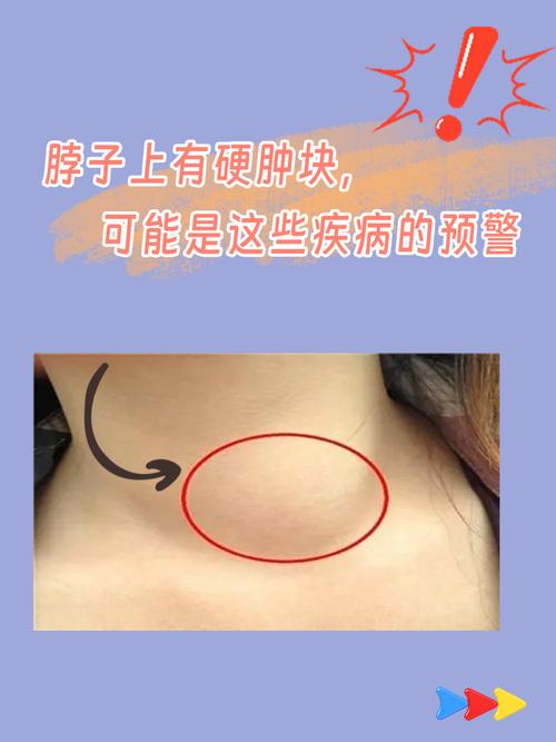 口腔溃疡伴颈部硬结是何原因?