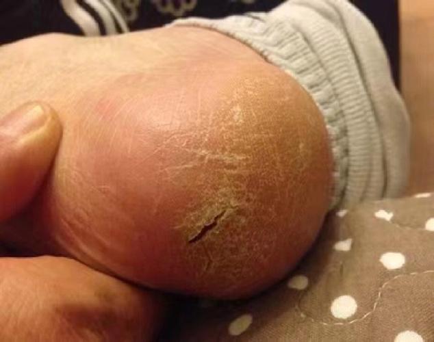 手脚皮肤干燥是哪些原因导致的?