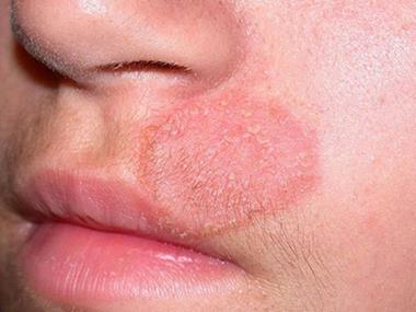 脸上真菌感染图片怎么辨别?