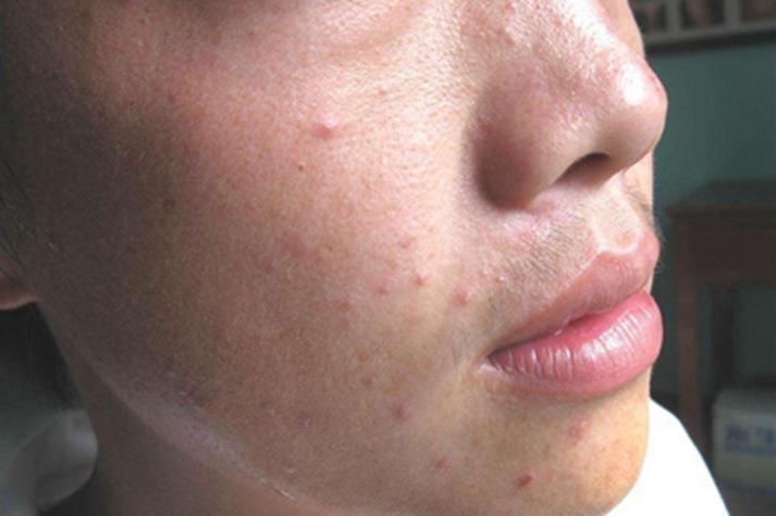 脸上真菌感染图片怎么辨别?