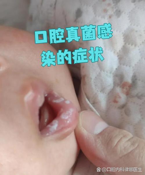 婴儿口腔两边发白图片