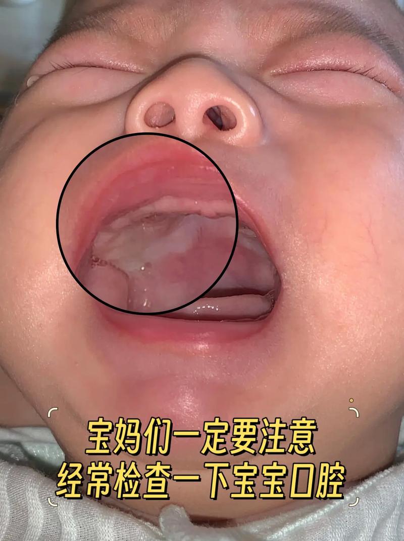 婴儿口腔两边发白图片
