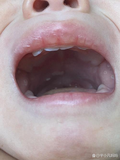 新生儿口腔内侧有白色