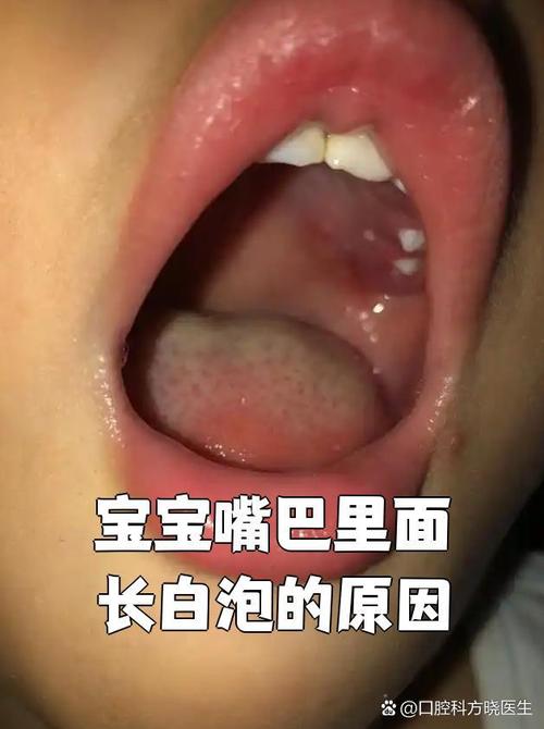 新生儿口腔内侧有白色