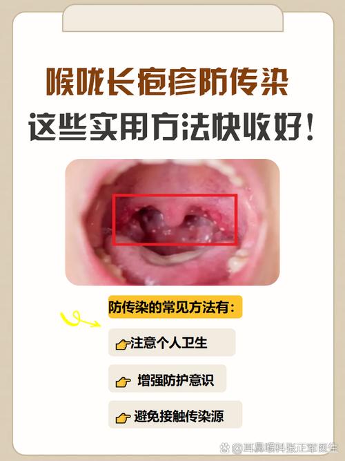 为什么有口腔疱疹病毒