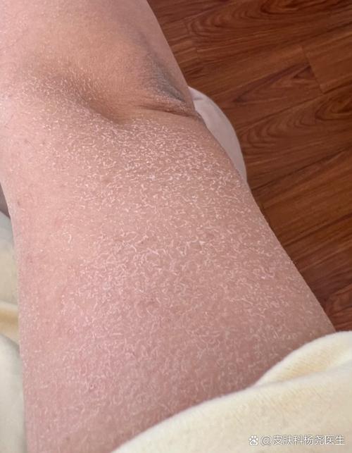 皮肤起皮屑像鱼鳞是什么原因?