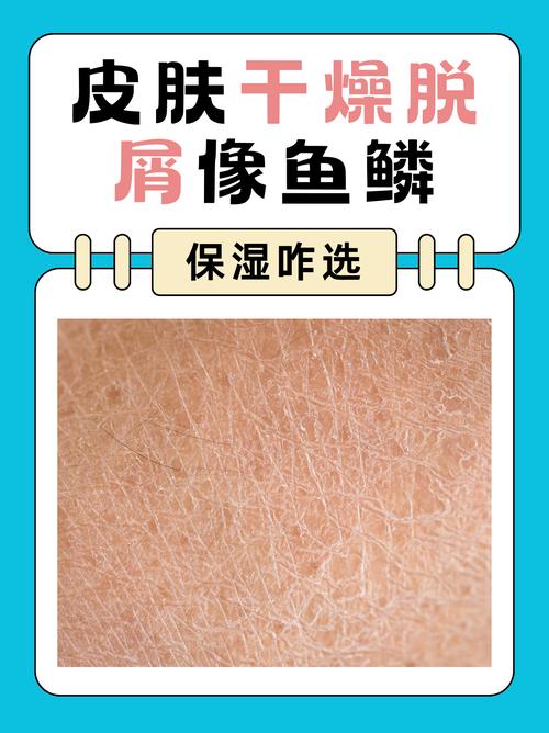皮肤起皮屑像鱼鳞是什么原因?