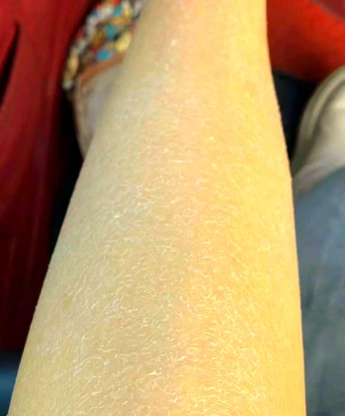 皮肤起皮屑像鱼鳞是什么原因?