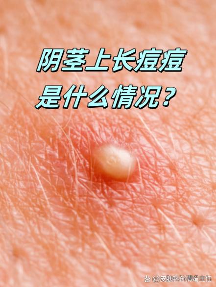 阴茎外皮肤好多小疙瘩