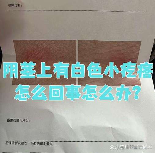 阴茎外皮肤好多小疙瘩