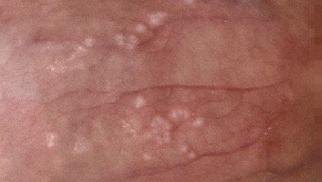 阴茎外皮肤好多小疙瘩