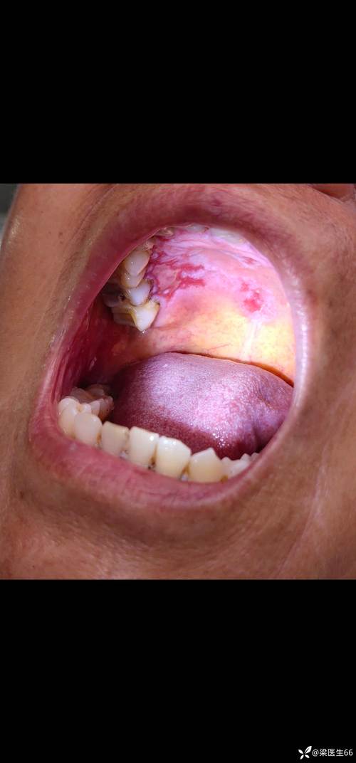 超大口腔溃疡图片大全