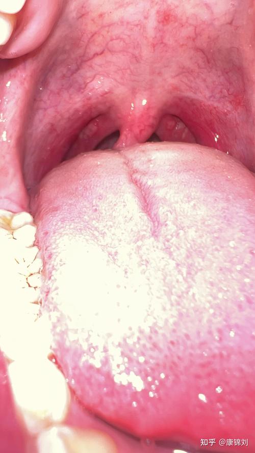 超大口腔溃疡图片大全