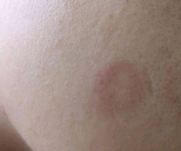 皮肤上圆形红斑是哪种疾病?