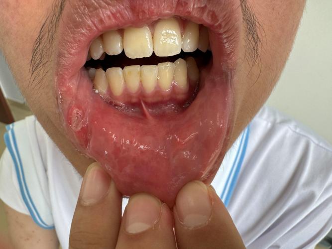 滴虫口腔炎的症状图片