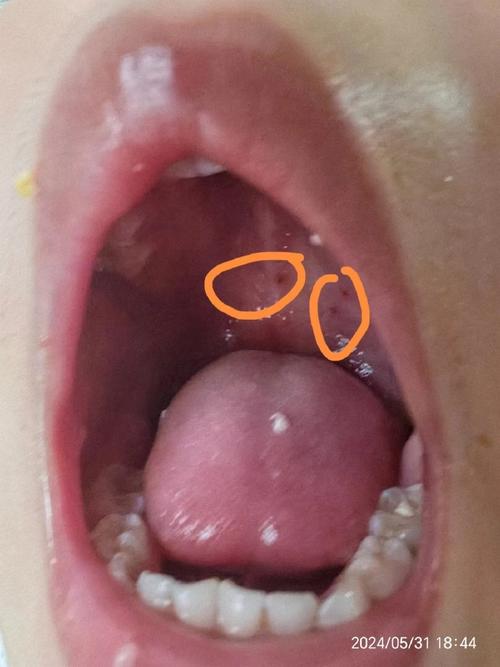 滴虫口腔炎的症状图片