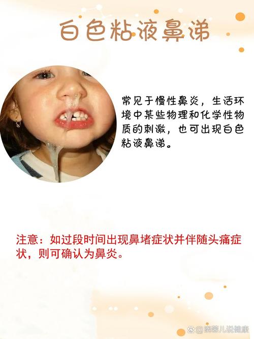 鼻涕倒流口腔恶臭,咋办?