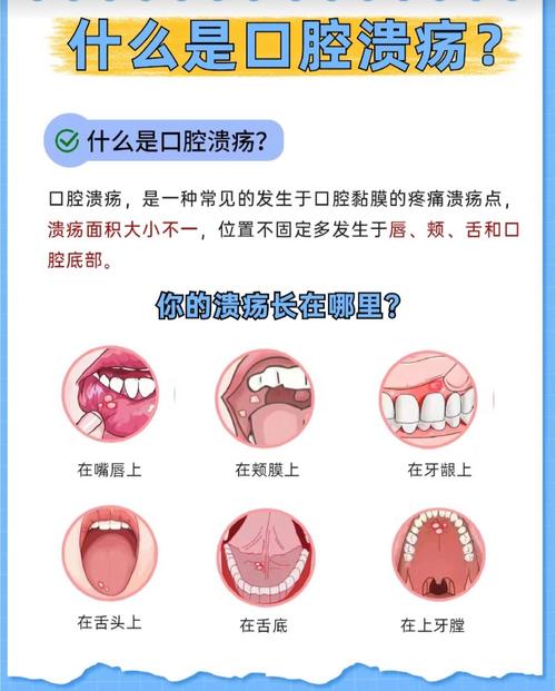 口腔粘膜出血怎么办?快速止血方法有哪些?