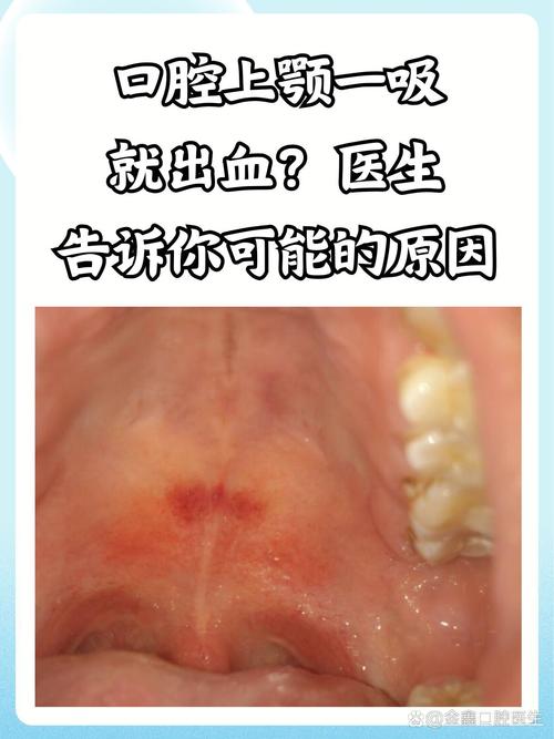每天早上起床口腔有血
