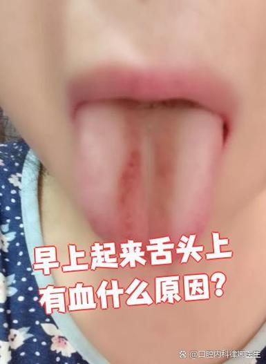 每天早上起床口腔有血