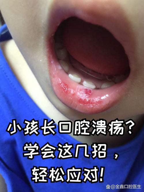 宝宝口腔溃疡吃什么饭能好得快?