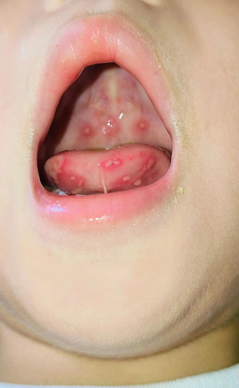 口腔透明水泡是啥原因?