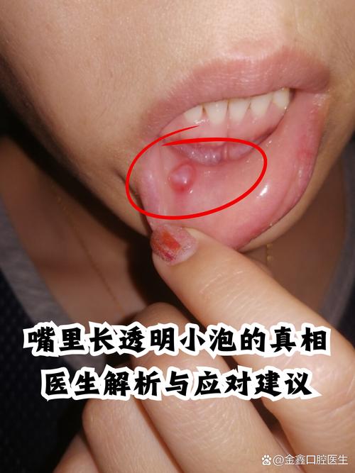 口腔透明水泡是啥原因?