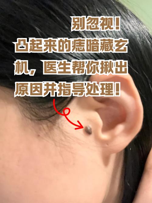 皮肤痣变大是危险信号吗?