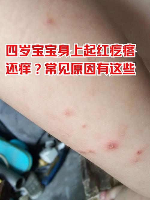 小孩皮肤痒一抓起疙瘩是过敏吗?