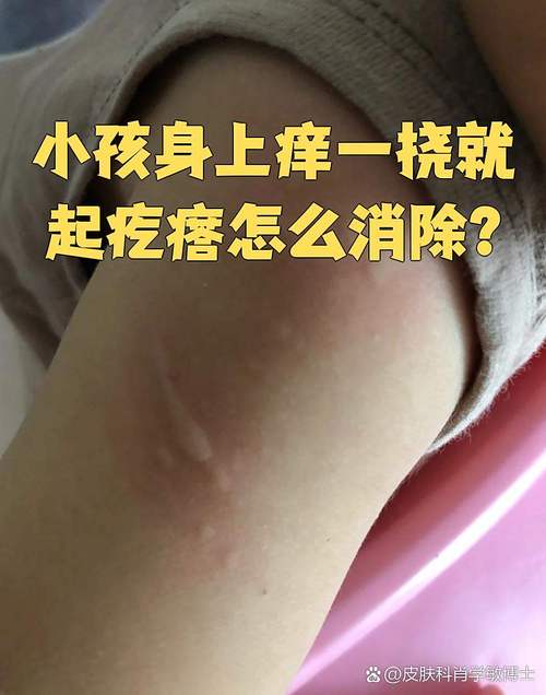 小孩皮肤痒一抓起疙瘩是过敏吗?