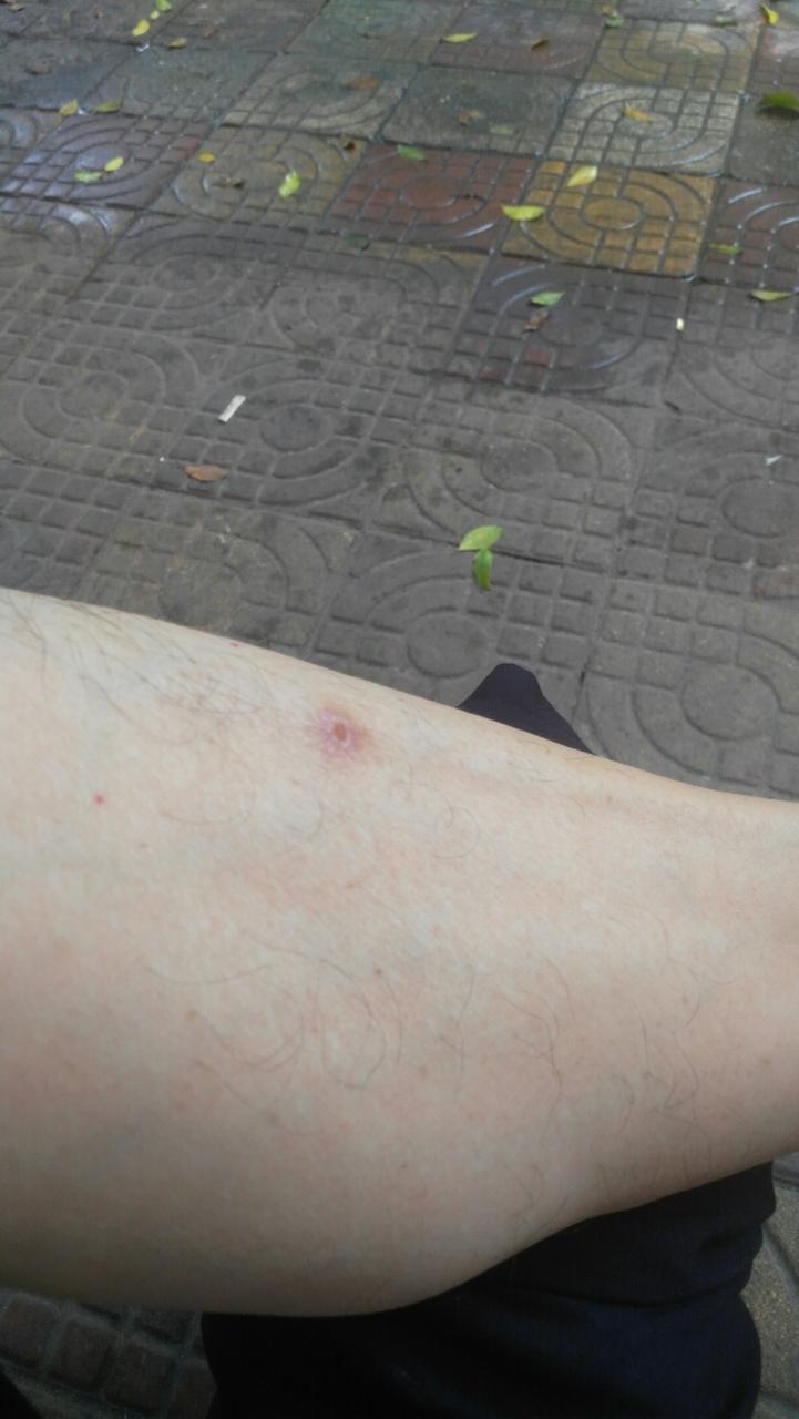 蜘蛛尿沾皮肤上该咋处理?