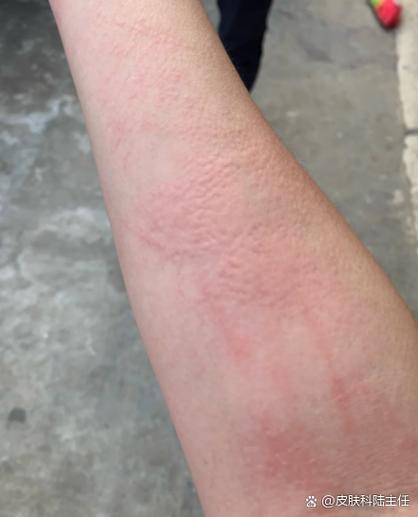 月子里皮肤痒是啥原因?