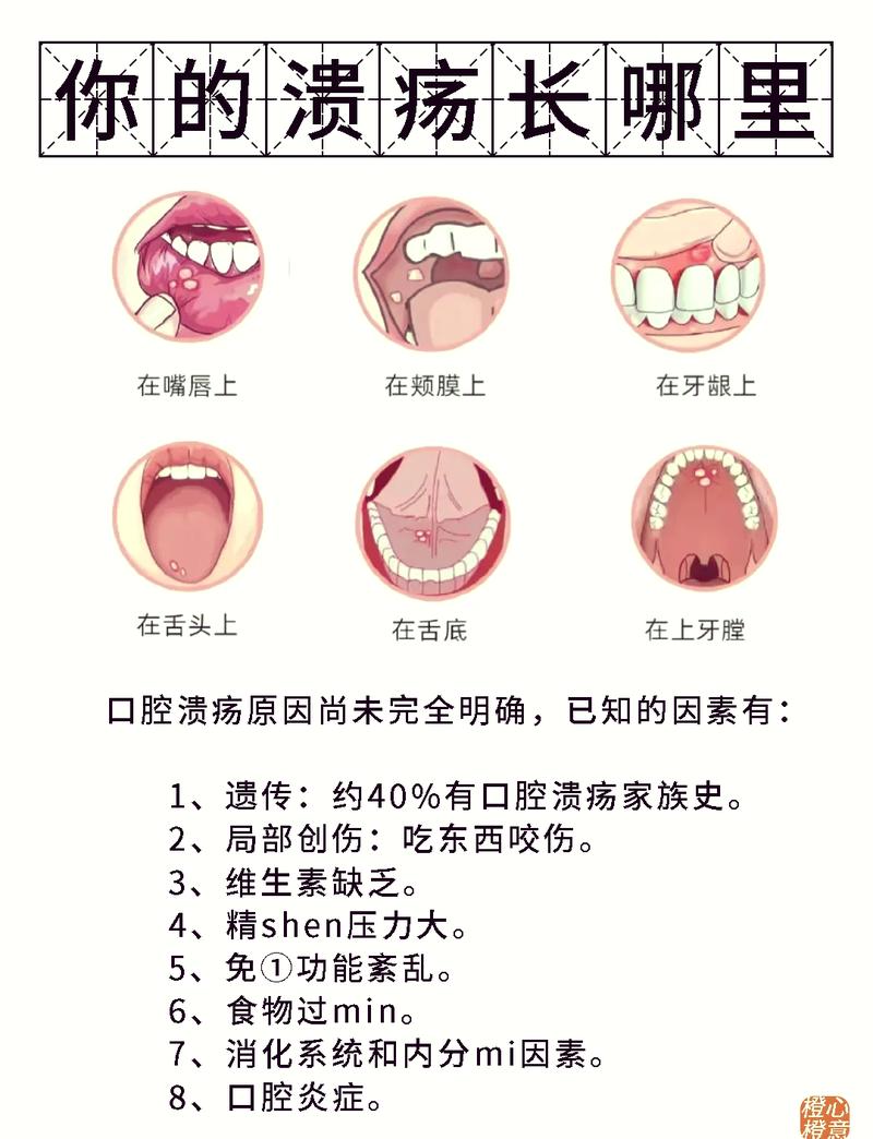 口腔溃疡土方法真的管用吗?